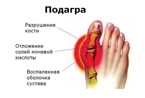 ЗАМЕНА КОЛЕННОГО СУСТАВА Грыжа шейного отдела позвоночника: симптомы и