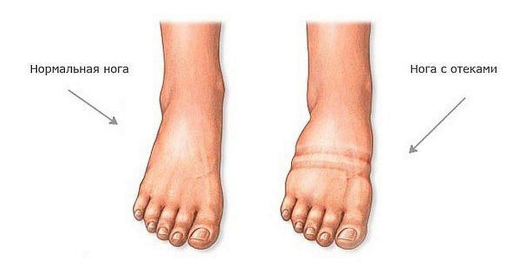 Отёк ступней ног: причины и лечение