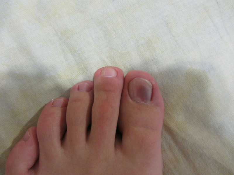 Синяк под ногтем большого пальца ноги: лечение подногтевой гематомы