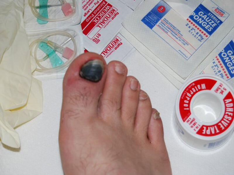 Синяк под ногтем большого пальца ноги: лечение подногтевой гематомы