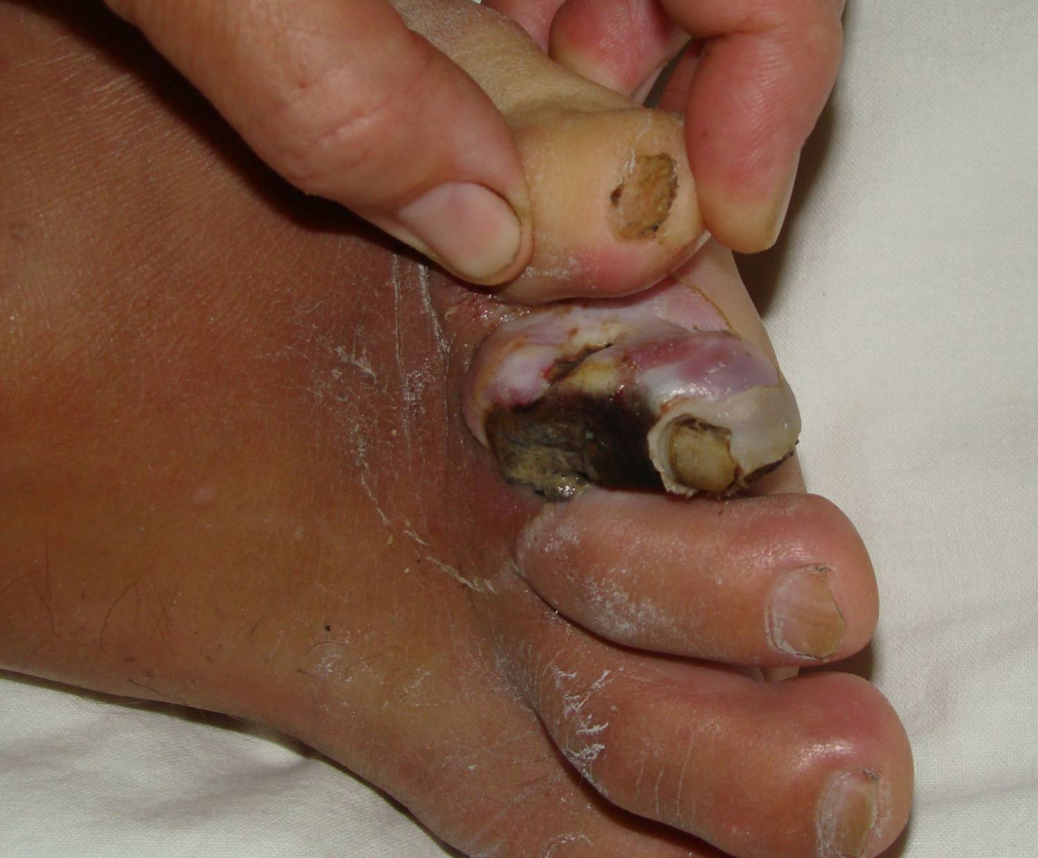 Первые признаки гангрены пальца ноги, симптомы и фото