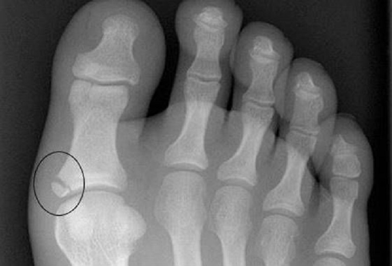 перелом большого пальца на ноге