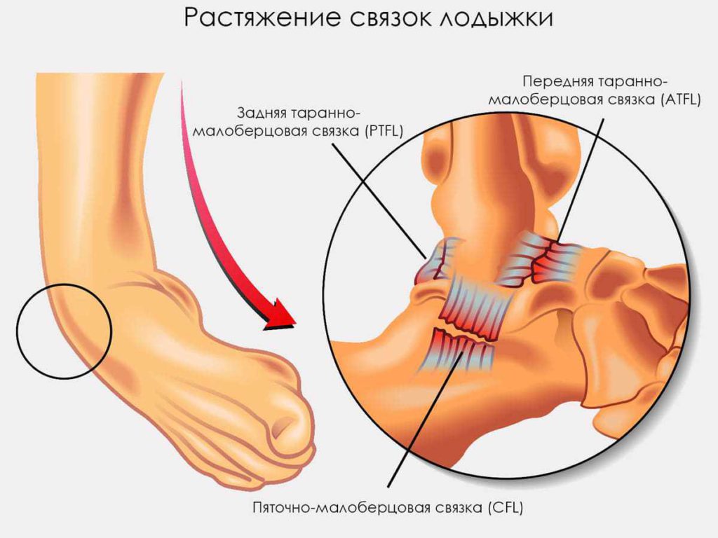 Что если ходить с растяжением связок Что если ходить с растяжением связок