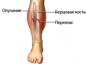 Как определить трещину в кости 🚩 если трещина на ноге симптомы 🚩 Здоровье и медицина 🚩 Другое