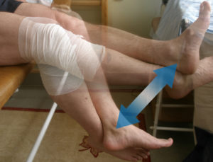 Реабилитация после эндопротезирования коленного сустава в Москве, восстановление после операции по замене колена: ЛФК, физиотерапия, массаж