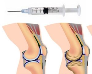 Гиалуроновая кислота для суставов: отзывы об уколах гиалурона, инъекции для коленных суставов