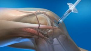 Гиалуроновая кислота для суставов: отзывы об уколах гиалурона, инъекции для коленных суставов