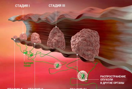 Сколько живут при раке груди 2 стадии и возможно ли полное излечение