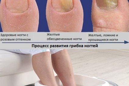 Ванночки против грибка ногтей
