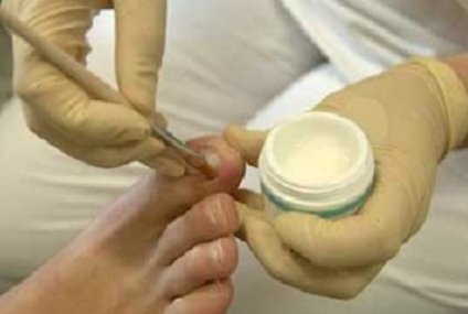 Выбираем эффективный пластырь от косточек на ногах