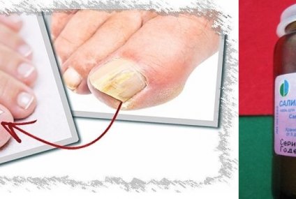 Салицилово-цинковая паста от грибка ногтей и стопы