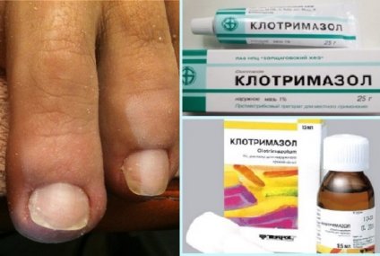 Клотримазол для лечения грибка ногтей на ногах
