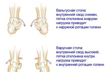 Ортопедические стельки для детей при вальгусе