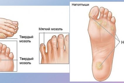 Как лечить мозоли на ступнях ног, их разновидности и причины появления