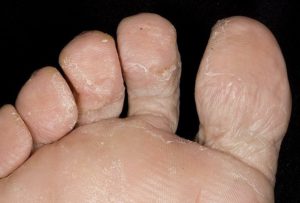 Поражение грибковыми спорами – одна из причин шелушения ног