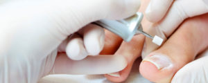 Удаление верхнего слоя ногтя для ускорения лечения