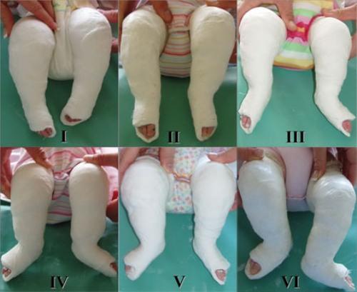 Вальгусная деформация стопы у новорожденного фото