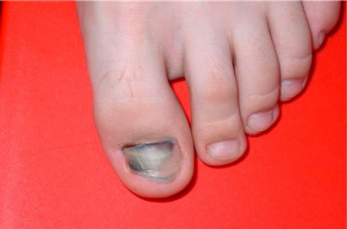 Посинели ногти на больших пальцах ног — вопрос №11097