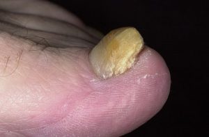 Болит ноготь на большом пальце