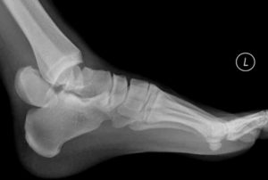 Рентгеновский снимок перелома таранной кости