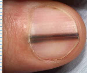 Черные полоски на ногтях нередко сигнализируют о развитии патологии в организме