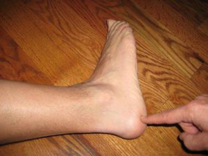 Причины жжения пяток ног