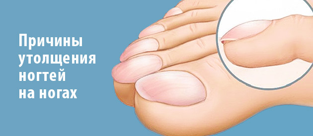 Как подстричь жесткие толстые ногти на больших пальцах ног у пожилых людей препараты средства и мази