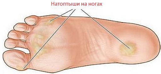 Мази, крема и средства от натоптышей на ногах: как использовать и применять