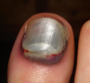 Гематома на ногте большого пальца ноги – результат ушиба