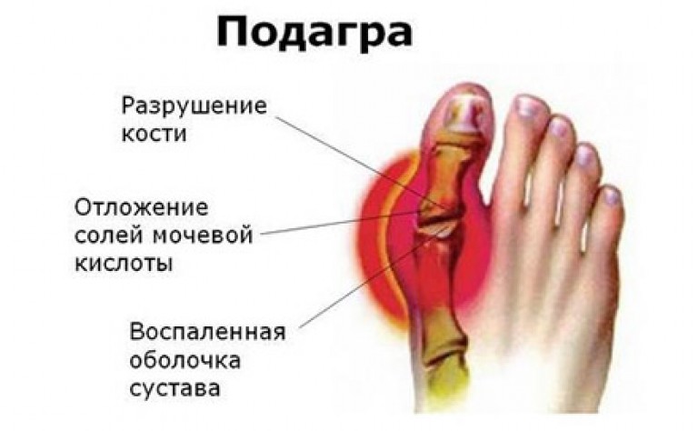 Подагра на большом пальце руки фото