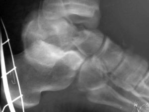  Рентгеновский снимок асептического некроза таранной кости