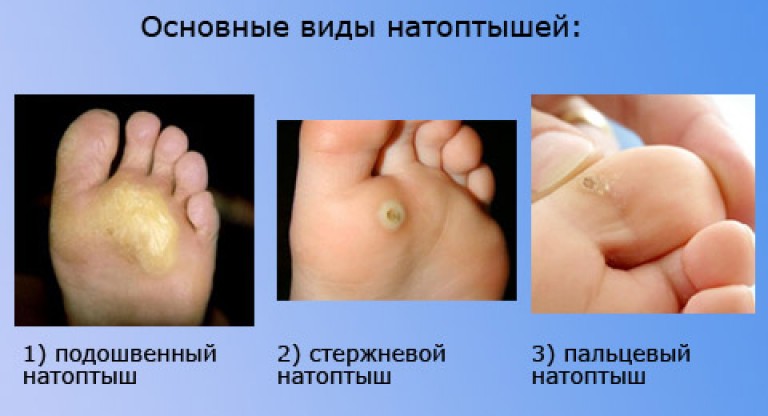 Как удалить шипицу (вывести ее на) 63 Как удалить шипицу (вывести ее на) 9
