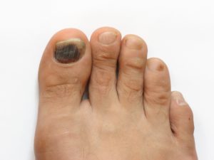 Слезают ногти на ногах лечение thumbnail