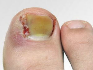 Панариций на большом пальце ноги лечение в домашних условиях фото thumbnail