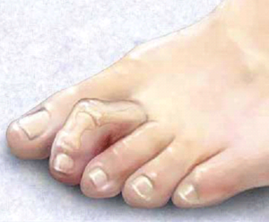 Молоткообразная деформация пальцев ног – лечение народными средствами