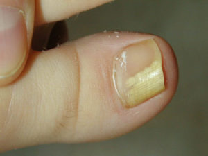 Пустота на ногте большого пальца ноги лечение thumbnail
