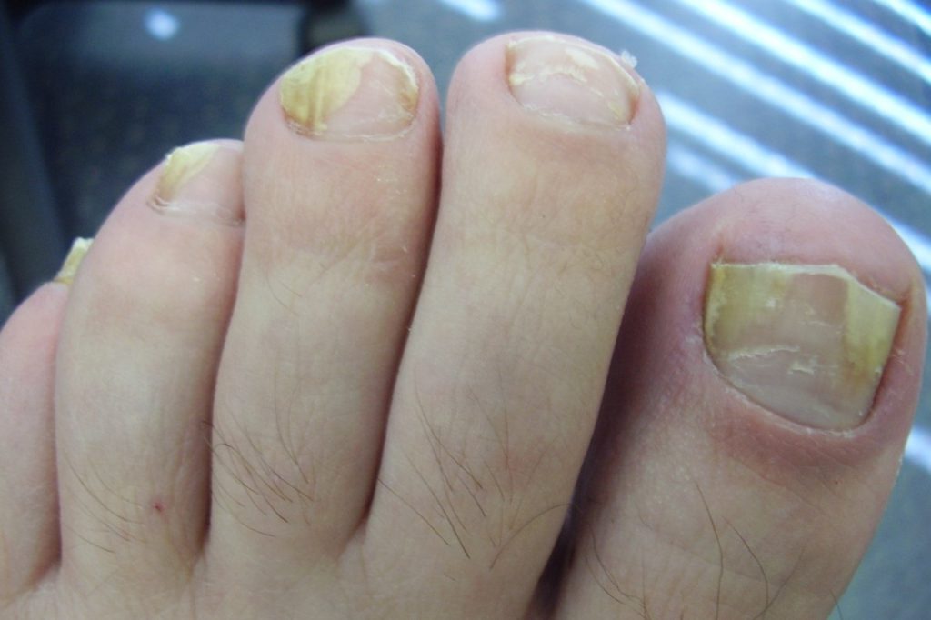 Деформация ногтей на ногах фото