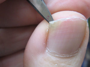 Пустота под ногтем большом пальце ноги лечение thumbnail