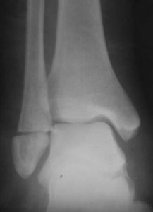 Рентгеновский снимок внутреннего перелома лодыжки со смещением