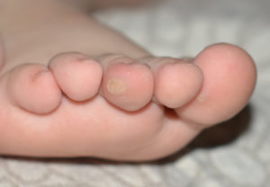 Бородавка на среднем пальце ноги