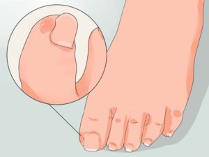 Признаки вросшего ногтя на большом пальце ноги