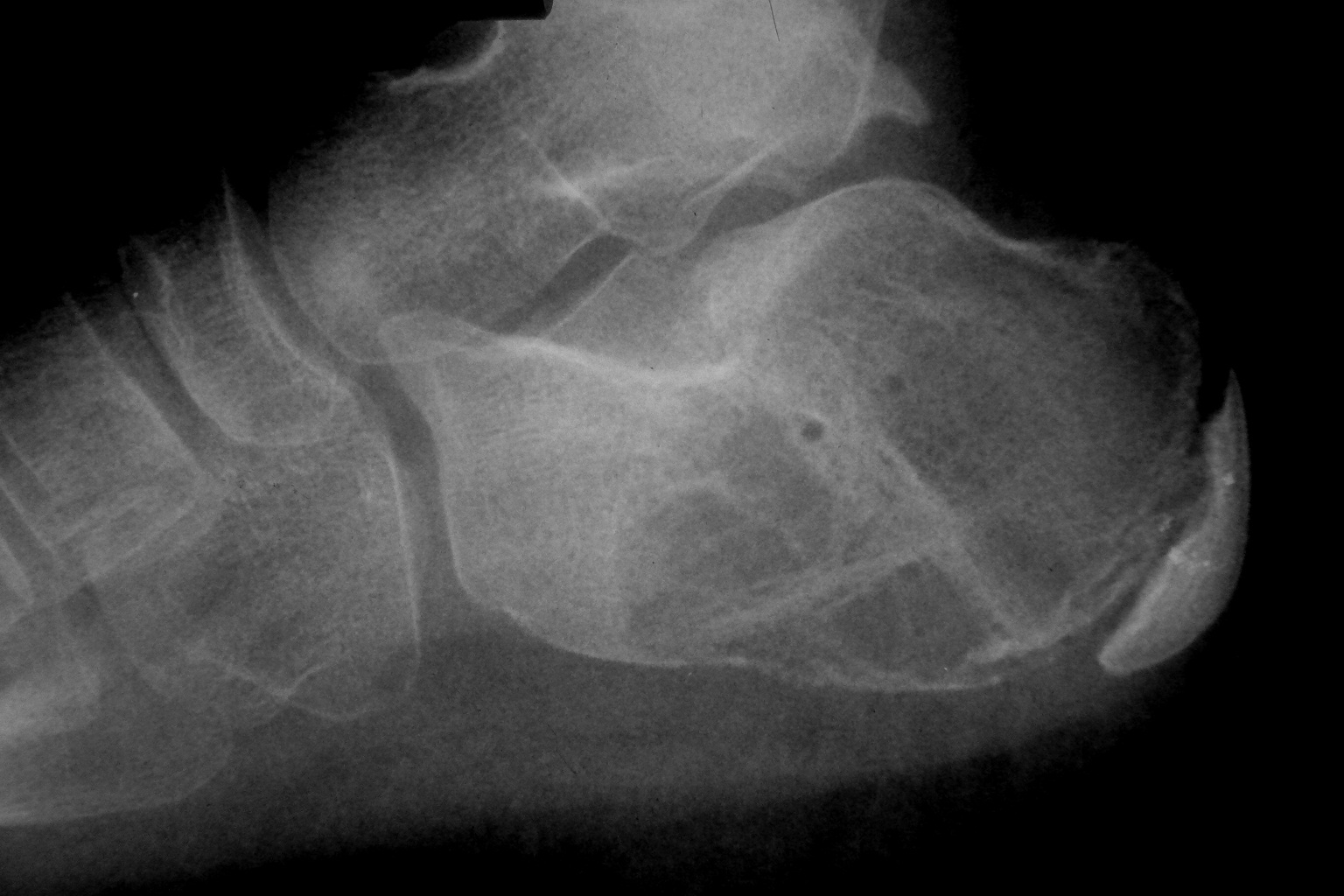 Пяточная кость рентген норма