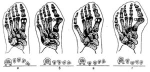 Разновидности деформации стопы