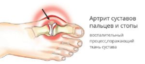 Воспалительный процесс при артрите