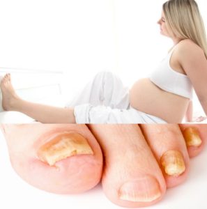 Грибок ногтей во время беременности