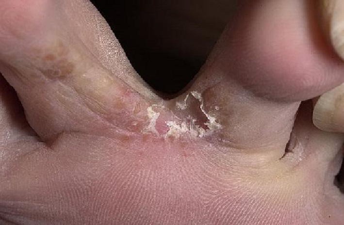Лечение опрелости между пальцами ног