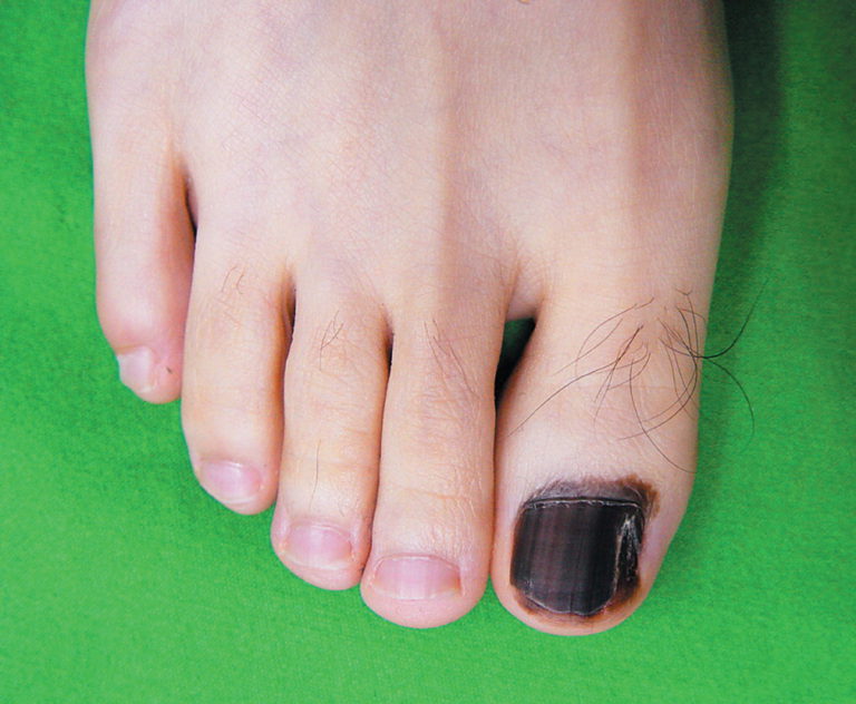 Подногтевая гематома на большом пальце ноги фото