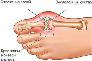 Воспаление стопы ноги симптомы и лечение