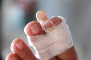 Перелом ногтевой бугристости большого пальца ноги thumbnail