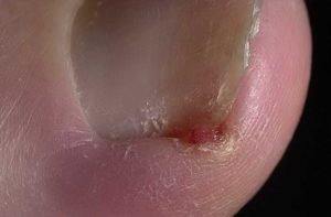 Рана из-за вросшего ногтя